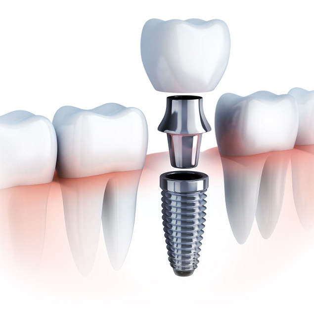 Implantes Dentales
